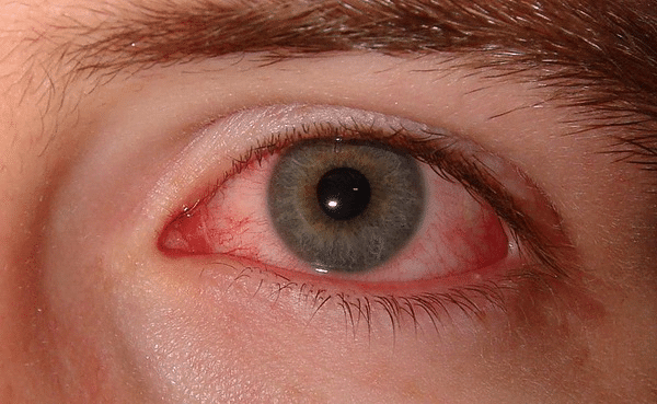 Red eye because of smoking marijuana